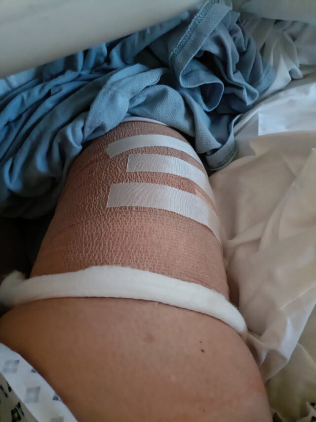 Knee Replacement, Knee Operation, Robotic Knee Operation, Ramsey Healthcare, Woodlands Hospital, Christmas, Festive Time, New Year, New Start, Physiotherapy, Knee Recovery